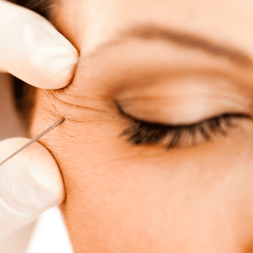Crows Feet Lines