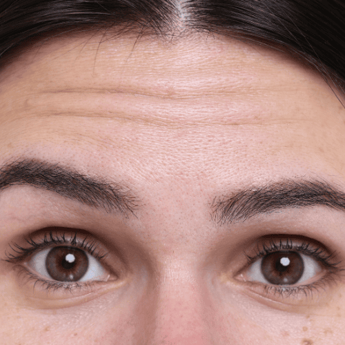Forehead lines